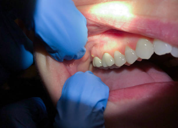 Best Broken or Cracked Tooth Emergency Dentist in Gratton, VA